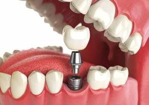 Импланты зубов Все на 4 имплантах. - Изображение #1, Объявление #1676158